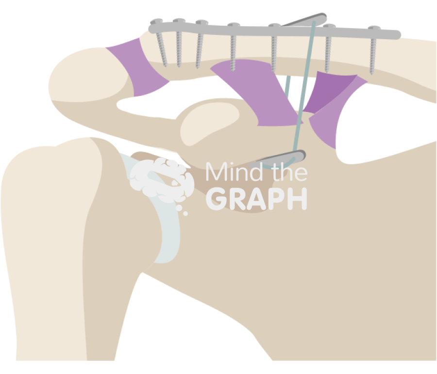 Free Distal clavicle anatomic plate cc sling Icons, Symbols, Pictures ...