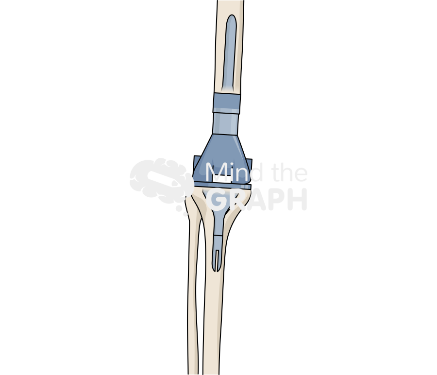 Distal femur replacement anterior posterior bone full Icons, Symbols, Pictures, and Images