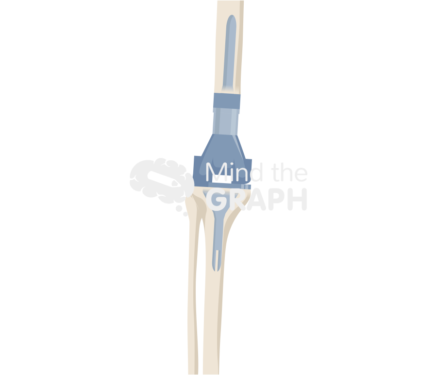 Distal femur replacement anterior posterior bone full Icons, Symbols, Pictures, and Images