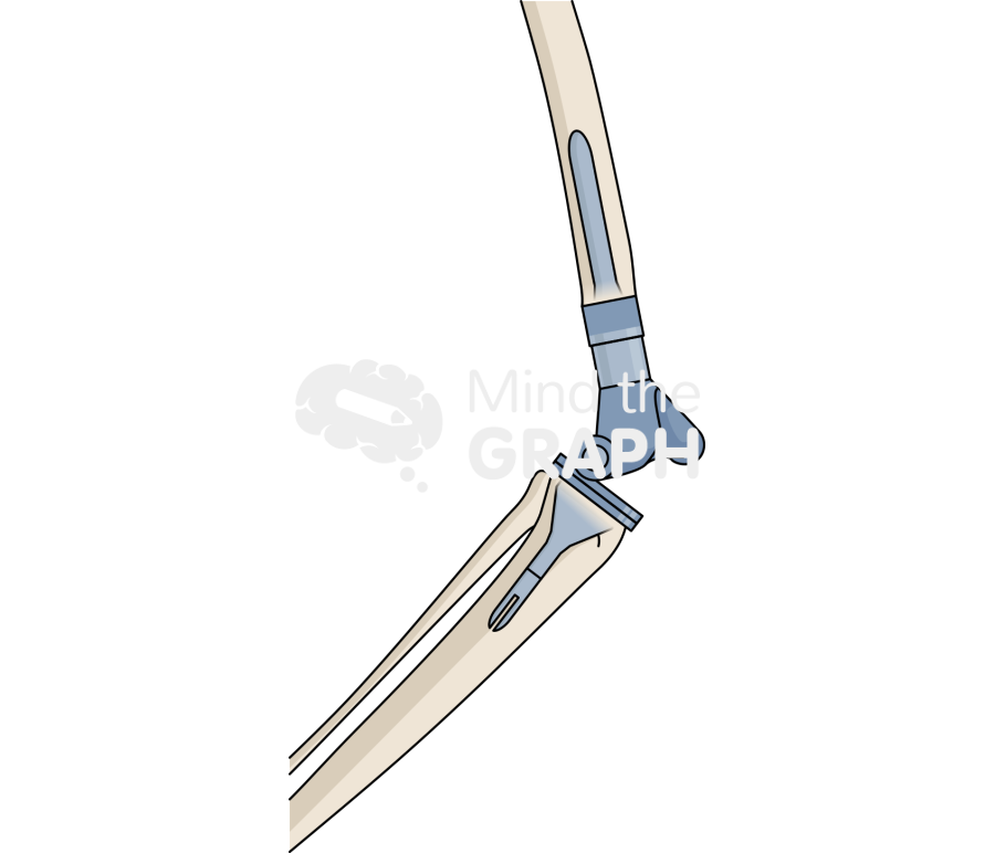 Distal femur replacement lateral bone full Icons, Symbols, Pictures, and Images