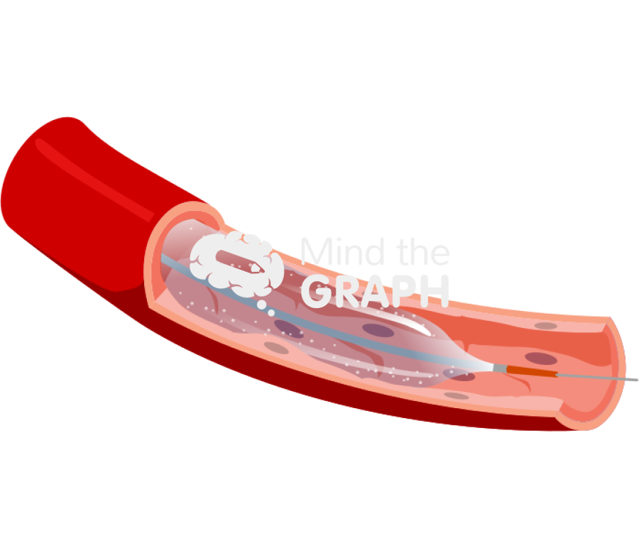 Drug coated balloons vessel Icons, Symbols, Pictures, and Images