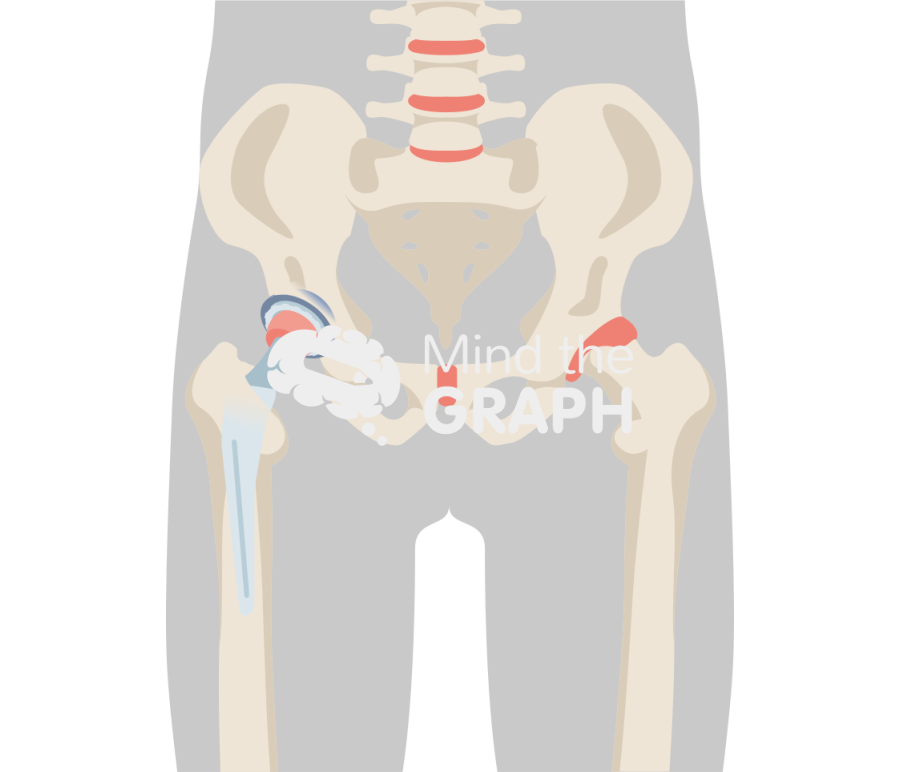 Dual mobility total hip arthroplasty body Icons, Symbols, Pictures, and Images