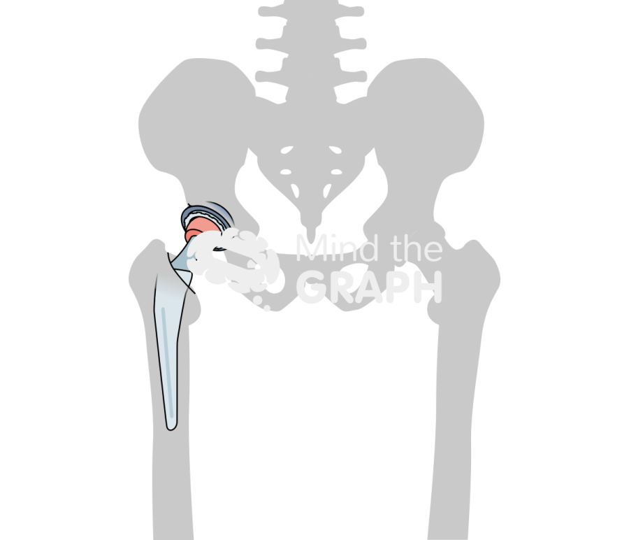 Dual mobility total hip arthroplasty bone Icons, Symbols, Pictures, and Images