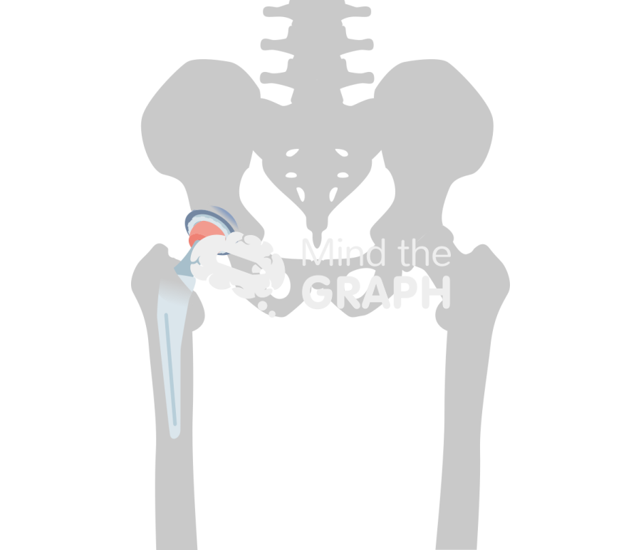 Dual mobility total hip arthroplasty bone Icons, Symbols, Pictures, and Images