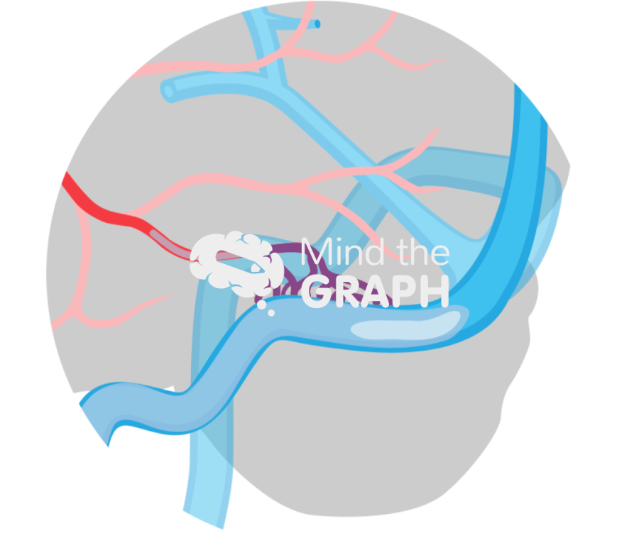 Dural arteriovenous fistula embolization liquid embolic 2 zoom Icons, Symbols, Pictures, and Images