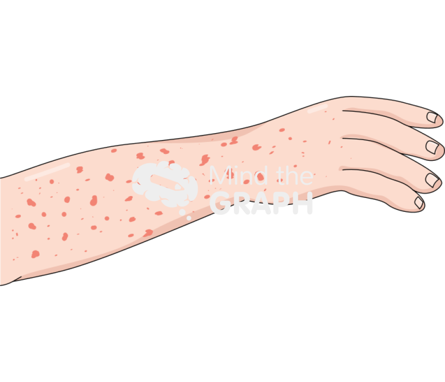 Ecchymosis hemorrhagic fever caucasian arm Icons, Symbols, Pictures, and Images