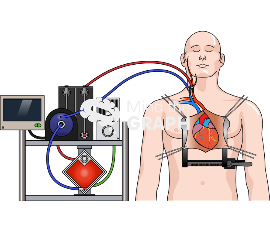 Open heart surgery ecmo Icons, Symbols, Pictures, and Images