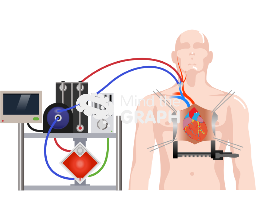 Open heart surgery ecmo Icons, Symbols, Pictures, and Images