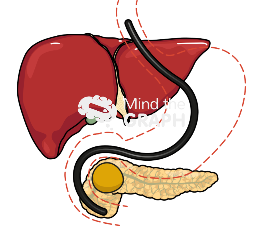 Endoscopic biopsy pancreatic mass