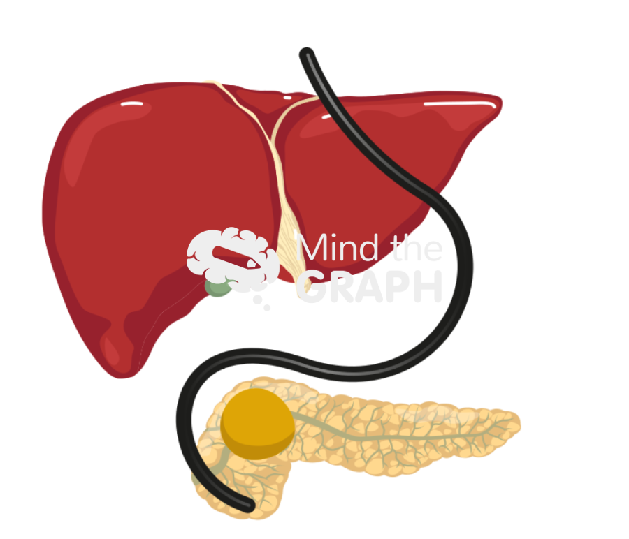 Endoscopic biopsy pancreatic mass Icons, Symbols, Pictures, and Images