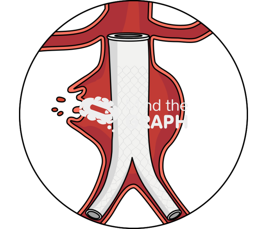 Endovascular repair evar ruptured abdominal aortic aneurysm aaa Icons, Symbols, Pictures, and Images