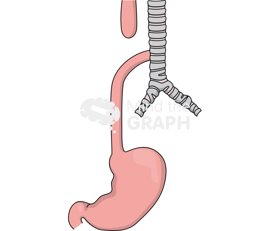 Esophageal atresia Icons, Symbols, Pictures, and Images