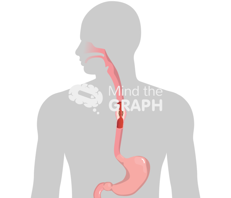 Esophageal cancer squamous cell carcinoma shape Icons, Symbols, Pictures, and Images