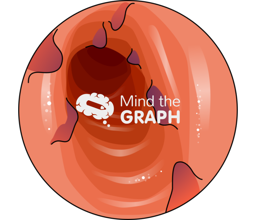 Esophageal varices zoom Icons, Symbols, Pictures, and Images