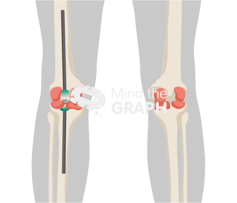 Exfix abx spacer anteroposterior body Icons, Symbols, Pictures, and Images