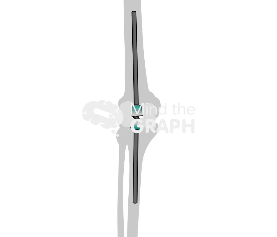 Exfix abx spacer anteroposterior bone Icons, Symbols, Pictures, and Images