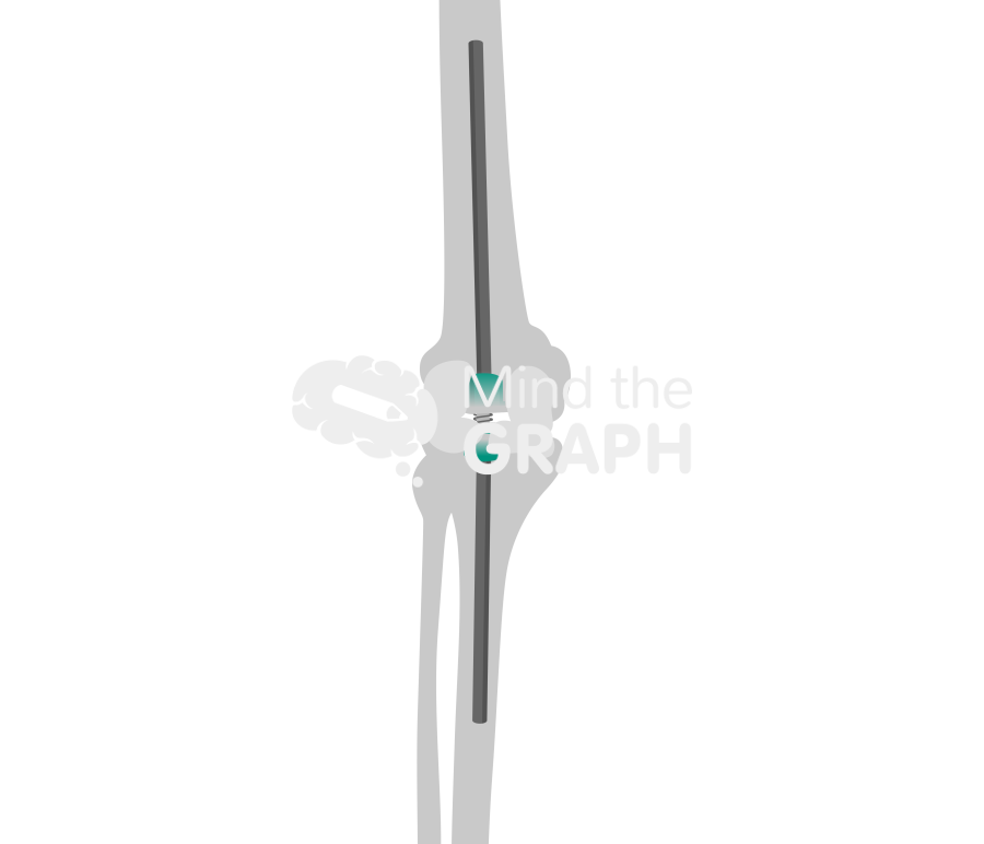 Exfix abx spacer anteroposterior bone Icons, Symbols, Pictures, and Images