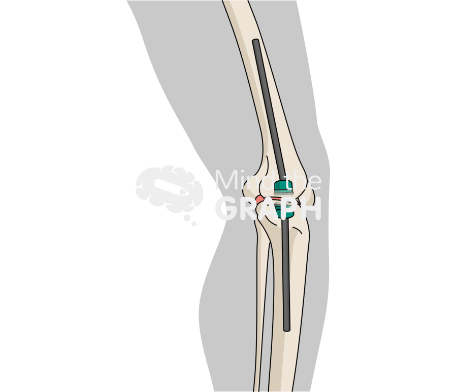Exfix abx spacer lateral body Icons, Symbols, Pictures, and Images