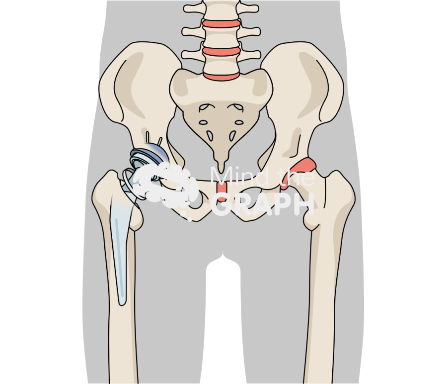Failed constraint total hip arthroplasty body Icons, Symbols, Pictures, and Images
