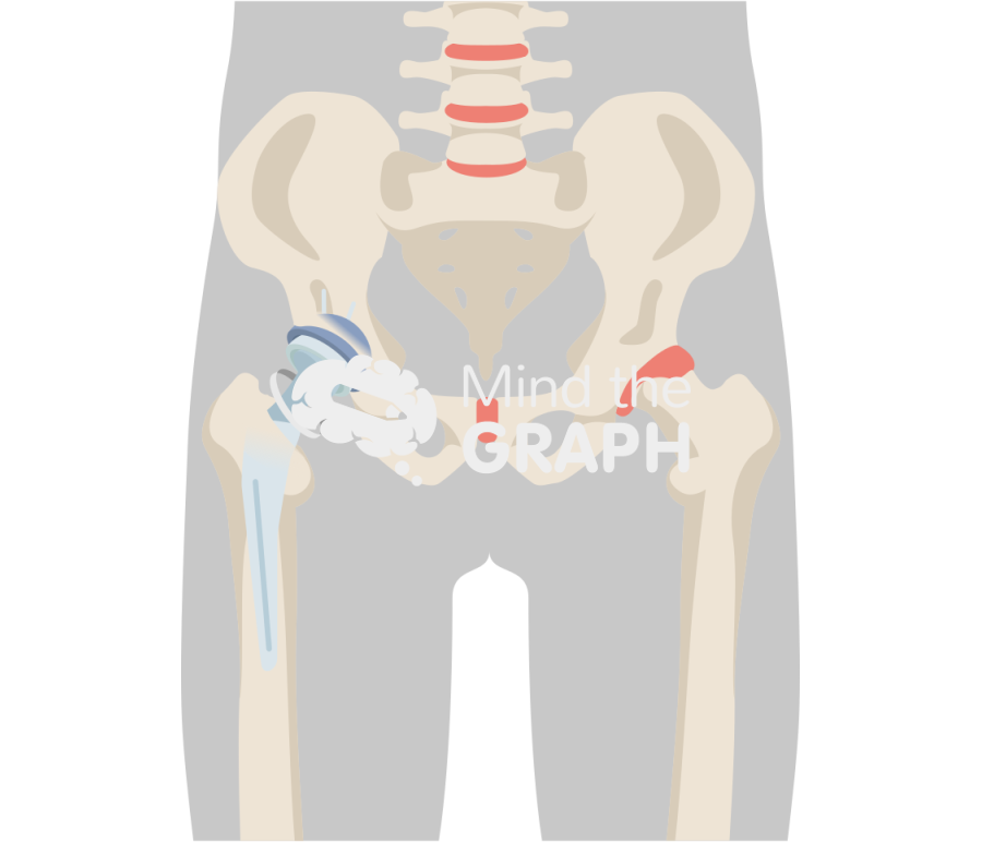 Failed constraint total hip arthroplasty body Icons, Symbols, Pictures, and Images