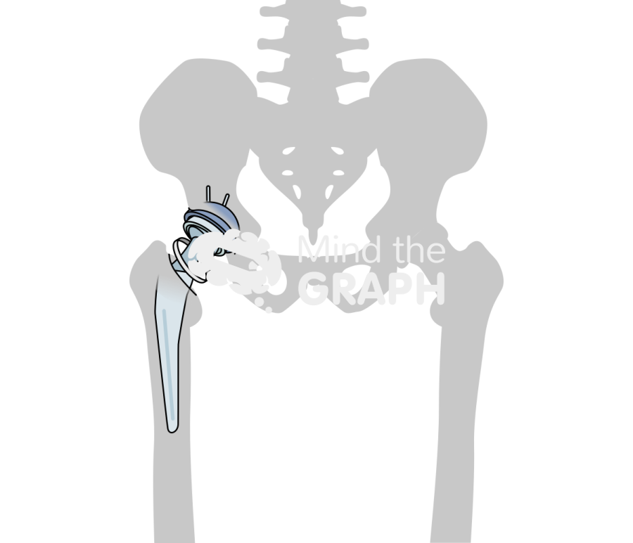 Failed constraint total hip arthroplasty bone Icons, Symbols, Pictures, and Images