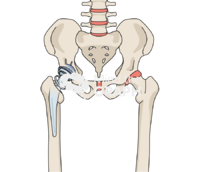 Failed constraint total hip arthroplasty bone full Icons, Symbols, Pictures, and Images