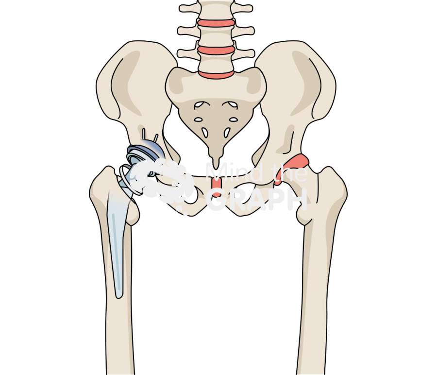 Failed constraint total hip arthroplasty bone full Icons, Symbols, Pictures, and Images