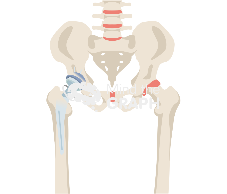 Failed constraint total hip arthroplasty bone full Icons, Symbols, Pictures, and Images