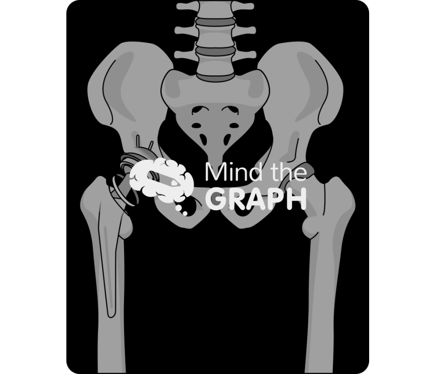 Failed constraint total hip arthroplasty x ray Icons, Symbols, Pictures, and Images