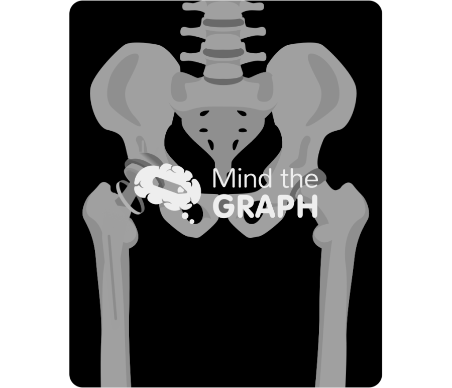 Failed constraint total hip arthroplasty x ray Icons, Symbols, Pictures, and Images