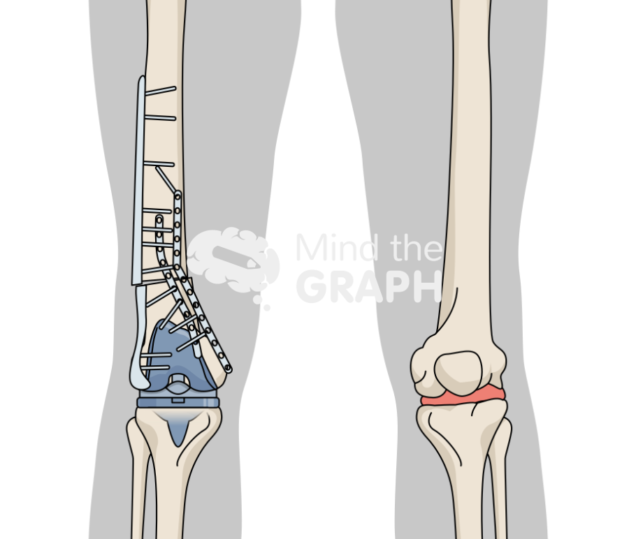 Failed open reduction internal fixation periprosthetic fracture total knee arthroplasty body Icons, Symbols, Pictures, and Images