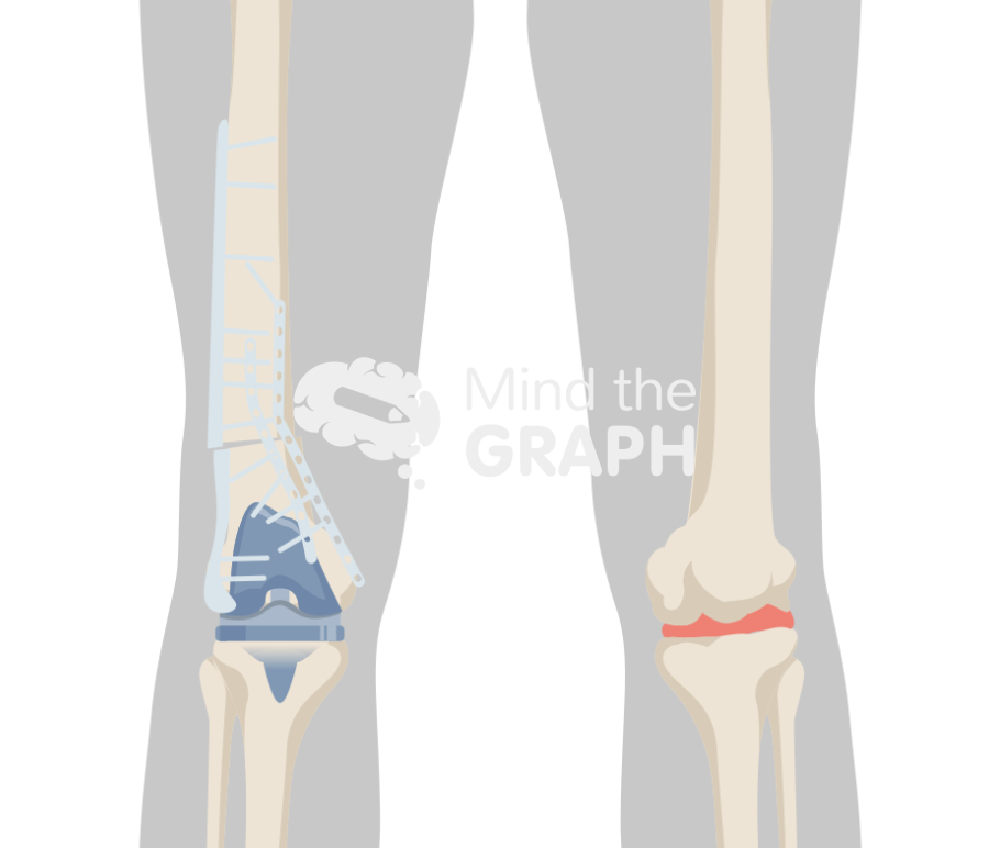 Failed open reduction internal fixation periprosthetic fracture total knee arthroplasty body Icons, Symbols, Pictures, and Images
