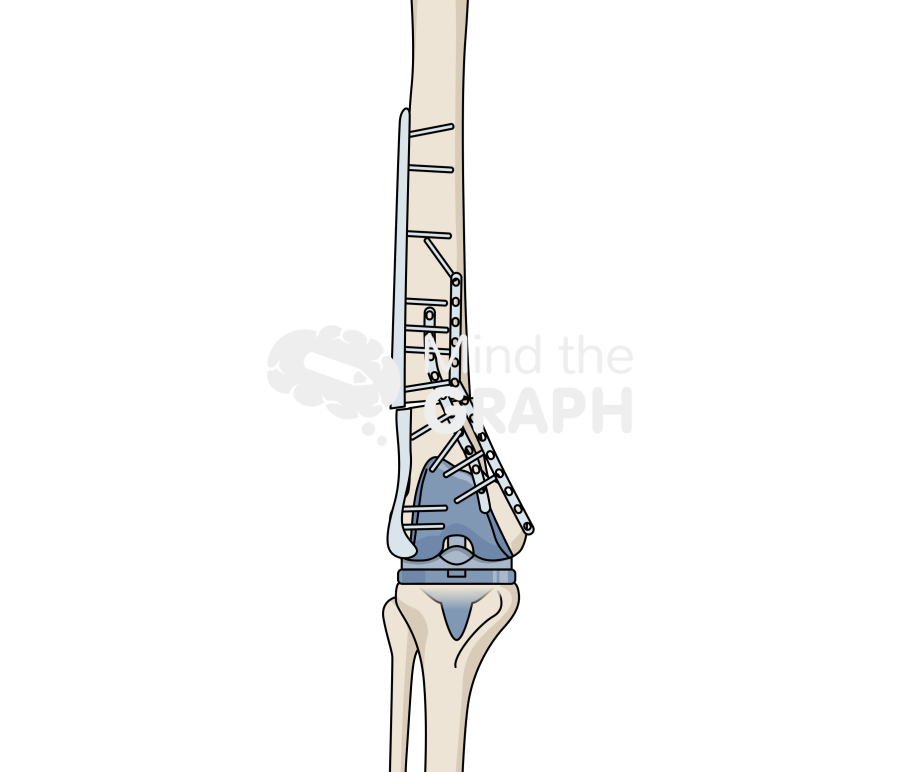 Failed open reduction internal fixation periprosthetic fracture total knee arthroplasty bone full Icons, Symbols, Pictures, and Images