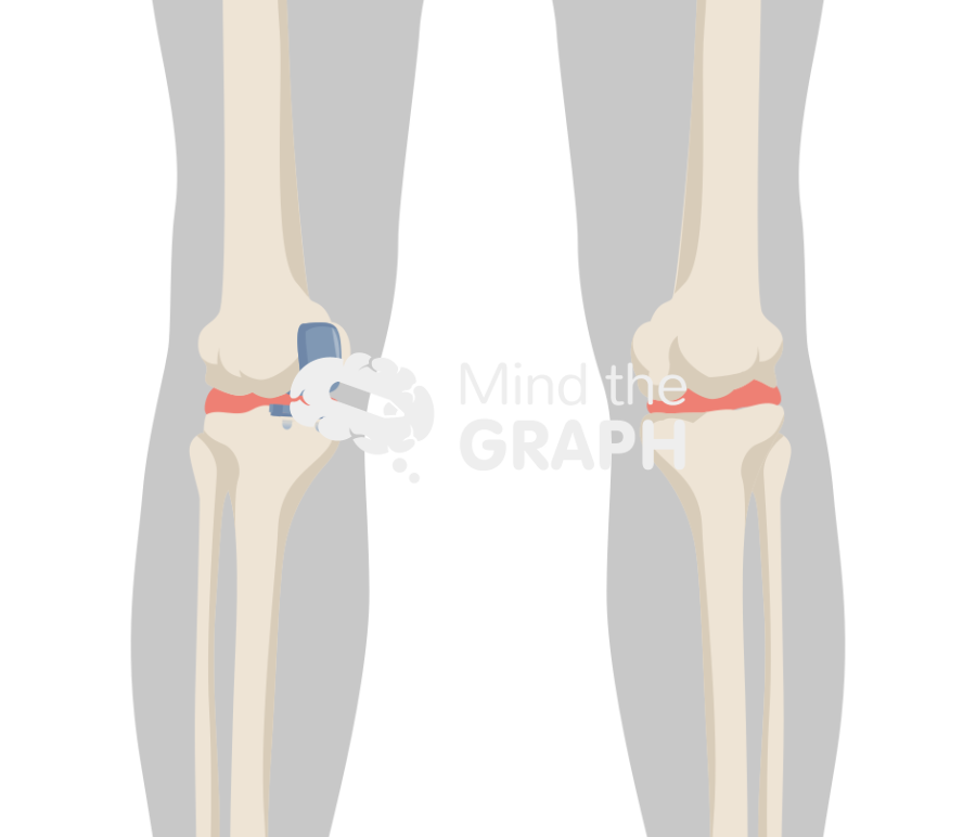 Femoral alignment unicompartmental knee arthroplasty 2 body Icons, Symbols, Pictures, and Images