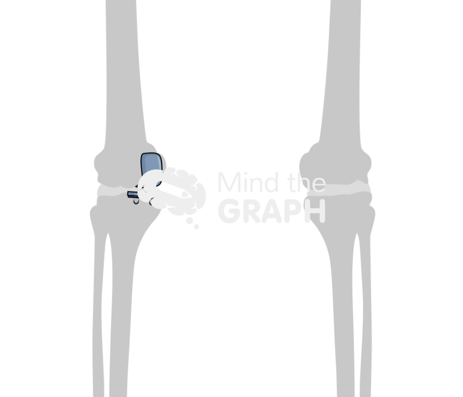 Femoral alignment unicompartmental knee arthroplasty 2 bone Icons, Symbols, Pictures, and Images