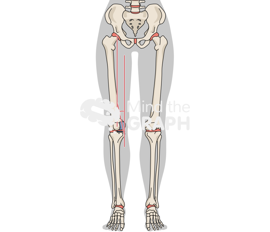 Femoral alignment unicompartmental knee arthroplasty body Icons, Symbols, Pictures, and Images