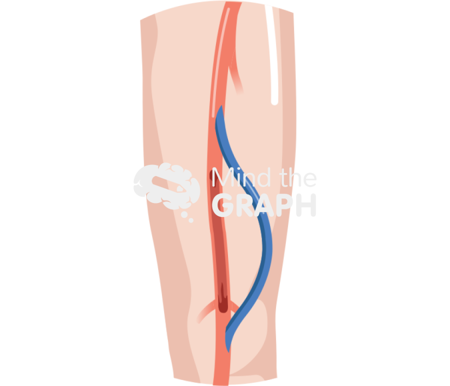 Femoral artery bypass zoom Icons, Symbols, Pictures, and Images