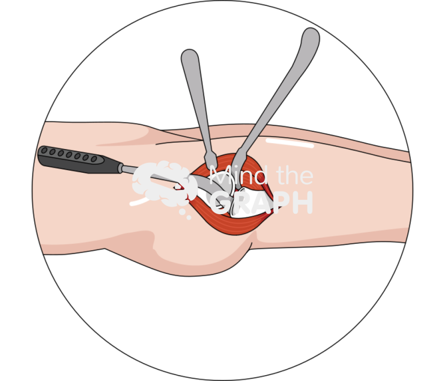Femoral exposure direct anterior approach zoom Icons, Symbols, Pictures, and Images