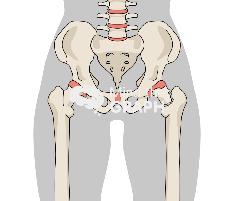 Femoral neck fracture 2 body Icons, Symbols, Pictures, and Images