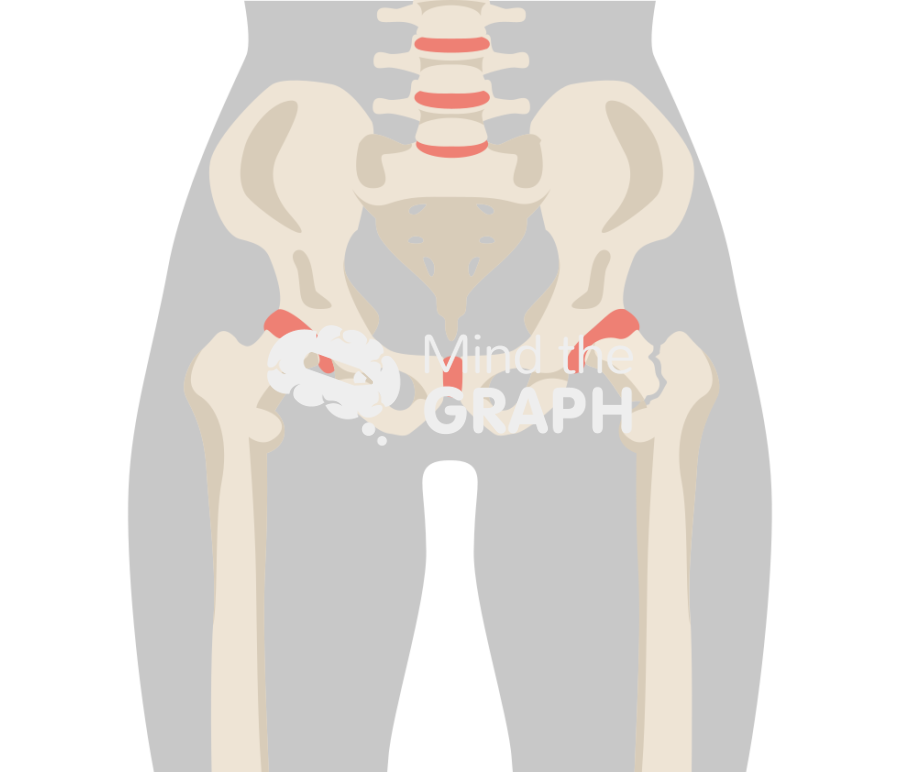 Femoral neck fracture 2 body Icons, Symbols, Pictures, and Images