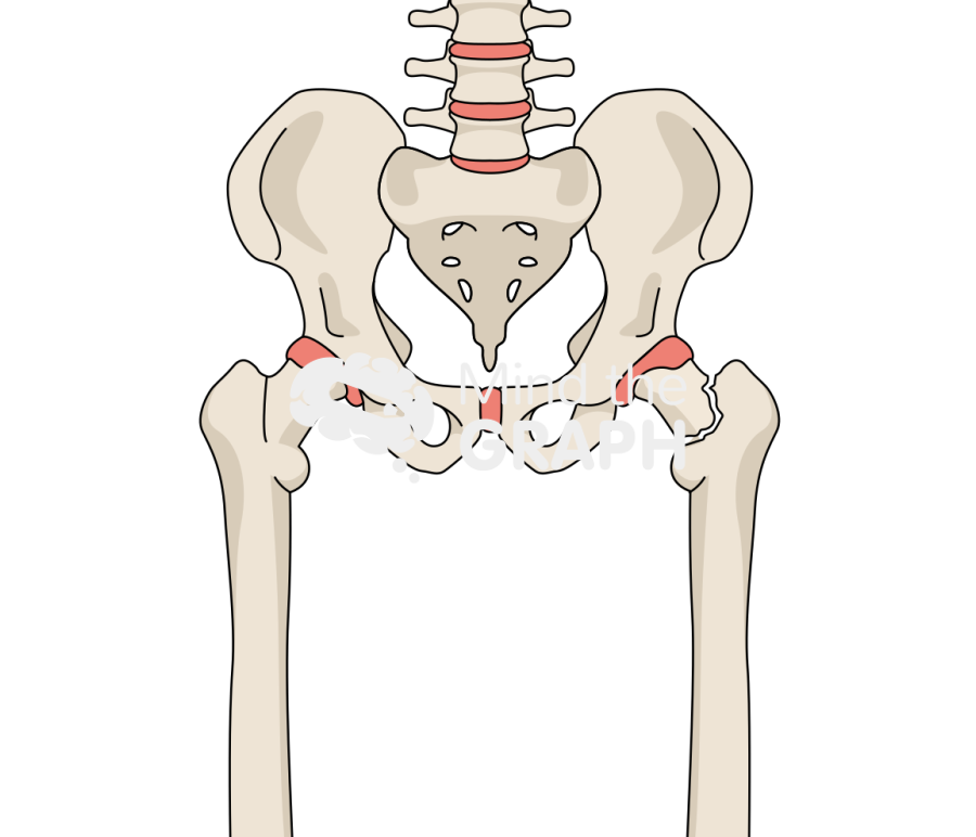 Femoral neck fracture 2 bone full Icons, Symbols, Pictures, and Images