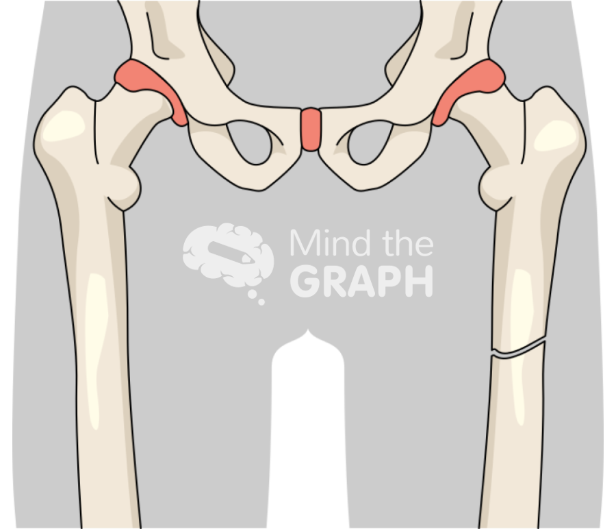 Femur fracture 1 Icons, Symbols, Pictures, and Images