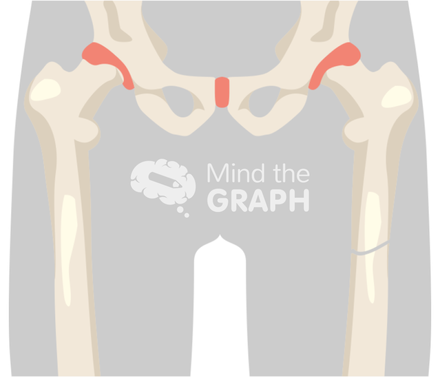 Femur fracture 1 Icons, Symbols, Pictures, and Images