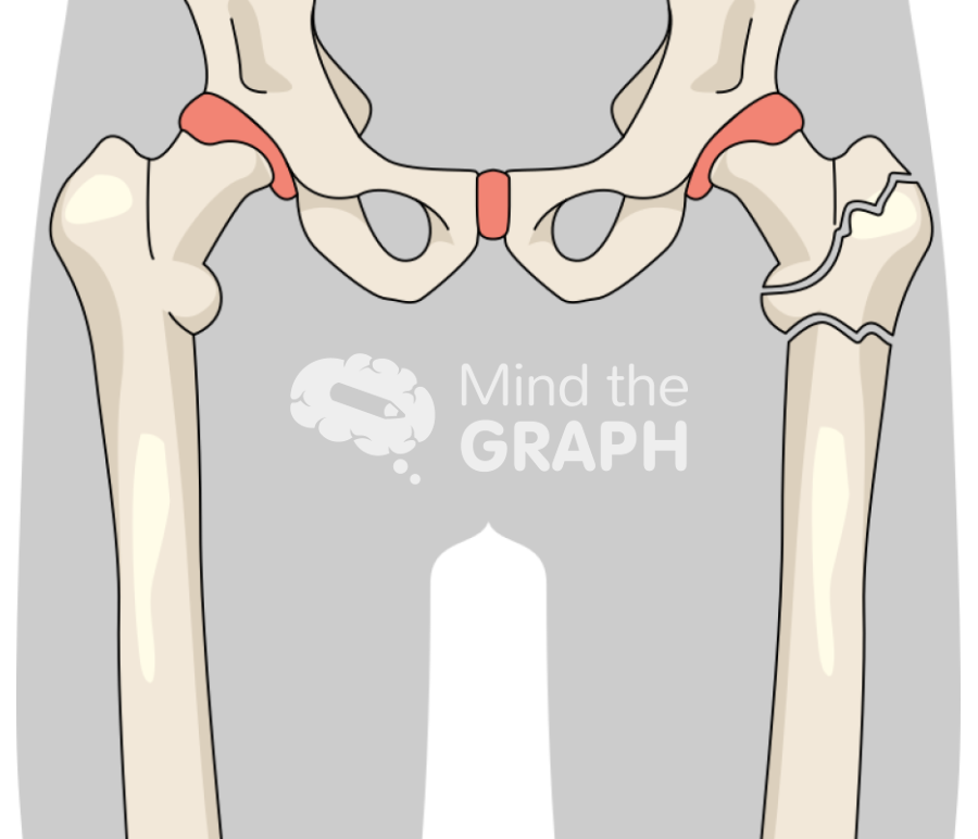 Femur fracture 5 Icons, Symbols, Pictures, and Images