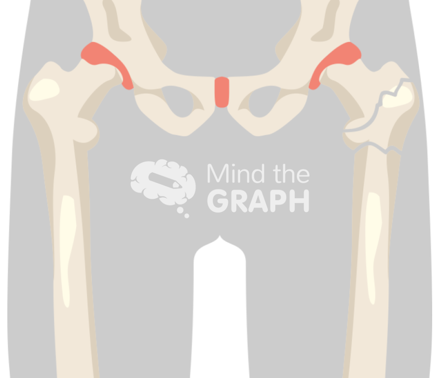 Femur fracture 5 Icons, Symbols, Pictures, and Images