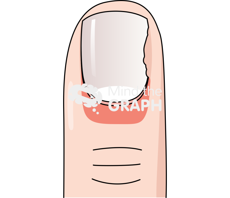 Finger nail surgery 1 Icons, Symbols, Pictures, and Images