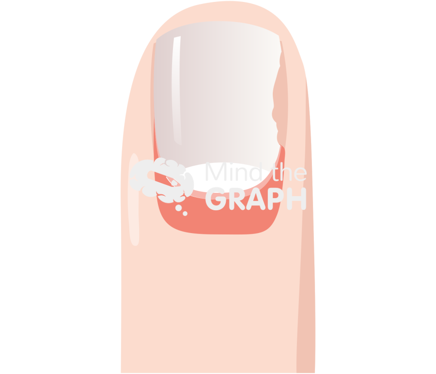 Finger nail surgery 1 Icons, Symbols, Pictures, and Images