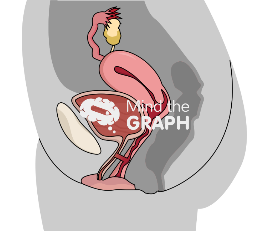 Fistula urethra vagina lateral cut Icons, Symbols, Pictures, and Images