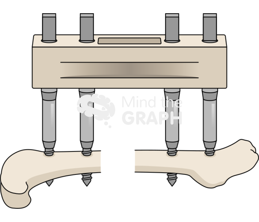 Fixateur externe bone Icons, Symbols, Pictures, and Images