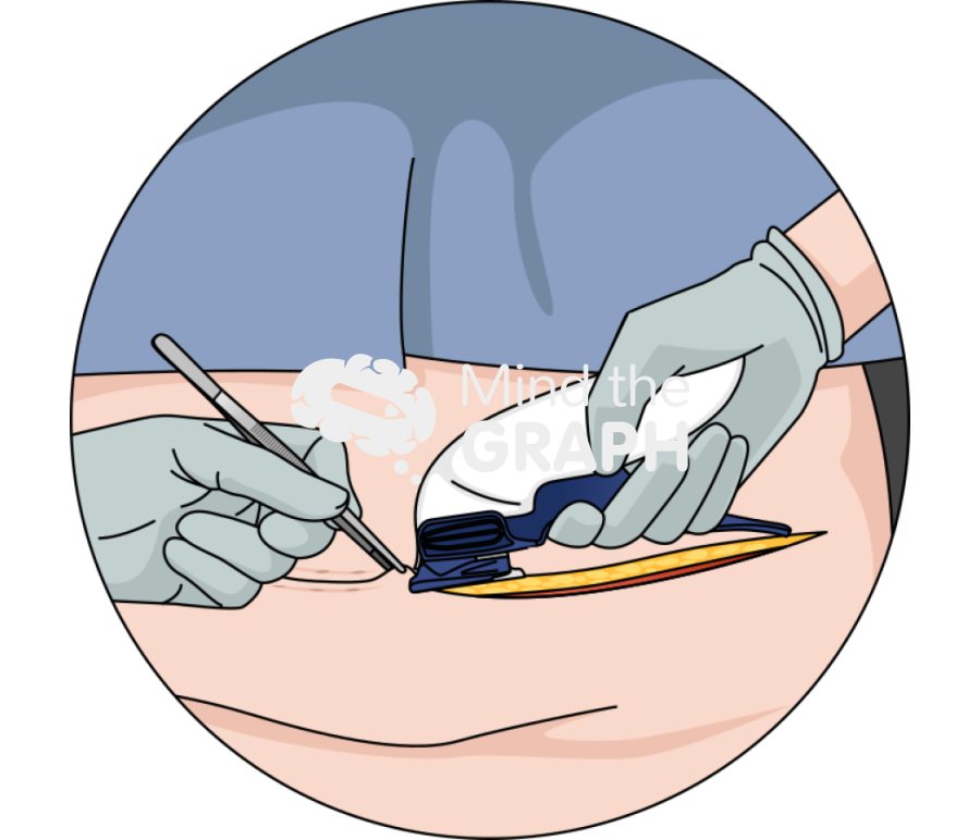 Fleur de lis panniculectomy closure zoom Icons, Symbols, Pictures, and Images